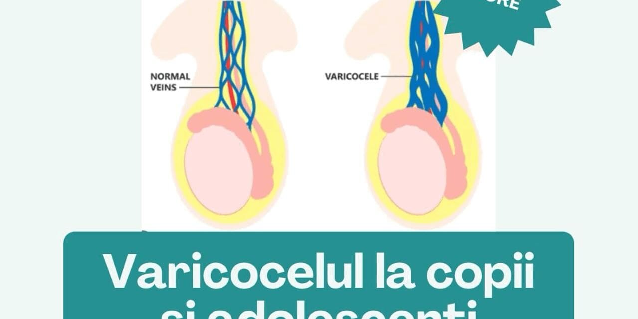Ce este varicocelul ? – Dr. Cimpeanu Ioana Patricia